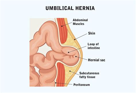 Umbilical Hernia after Delivery: Causes, Signs & Treatment