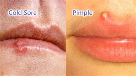 Pimple or Cold Sore: Difference, Causes, Prevention, And Treatment ...