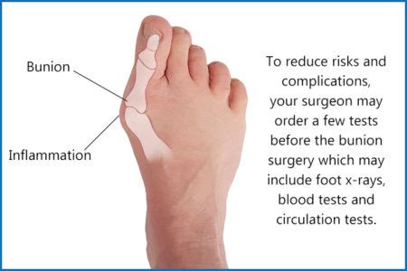 Bunion Surgery: Complications & Recovery Time - eMediHealth