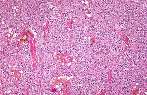 Oligodendroglioma; Oligodendroblastoma