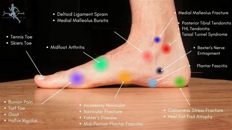 Foot Pain Chart: Top of Foot, Side and Front of Foot Pain Chart