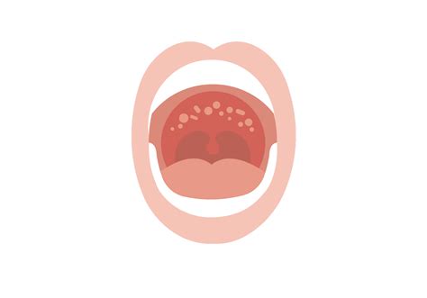 Floor Of Mouth Hurts When Swallowing | Viewfloor.co