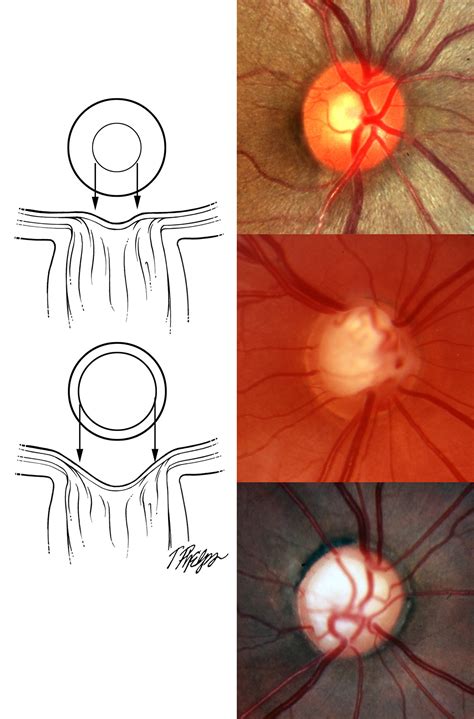 Ophthalmoscopy Glaucoma at Raymond Gautier blog