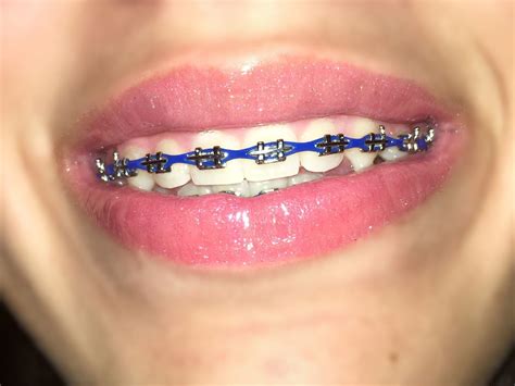 Blue braces Dark Blue Braces, Dental Braces, Braces Teeth Colors, Cute Braces Colors, Teeth ...