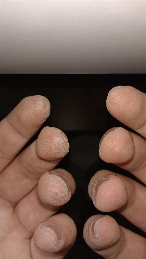 My fingers after playing guitar for 3 years every single day. : r/mildlyinteresting