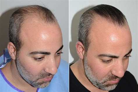 Hair Transplants for Men photos | Miami, FL | Patient59522