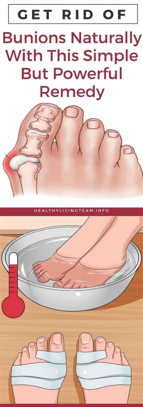 Get Rid of Bunions Naturally With This Simple But Powerful Remedy Would you like to be able to ...