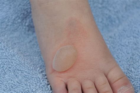 Skin Lesions: Types with Chart, Pictures, Causes, Treatment