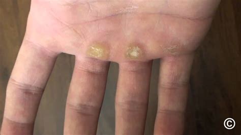 CORNS AND CALLOSITIES (syn. calluses)