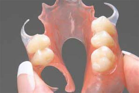 A Partial Denture