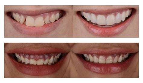 Transform Your Teeth with Clear Aligners: Before and After Pictures