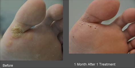 Wart Treatment San Ramon | Wart Removal | Wart Therapy