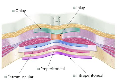 EuraHS terminology of mesh positions during ventral hernia repair ...