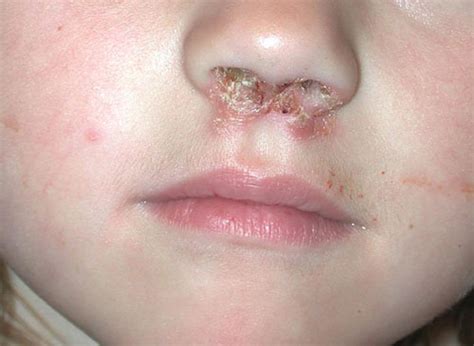 Impetigo: What to Know About This Common Skin Infection in Children - HealthyChildren.org