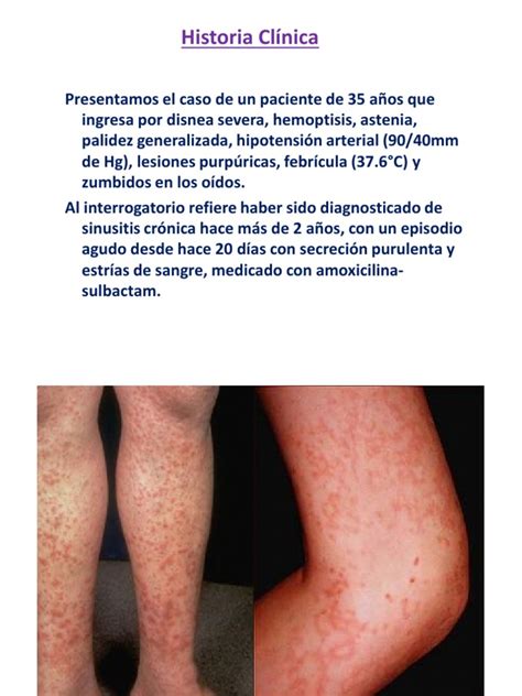 7- Vasculitis Wegener .Gnre. Les | Medicina Interna | Especialidades ...