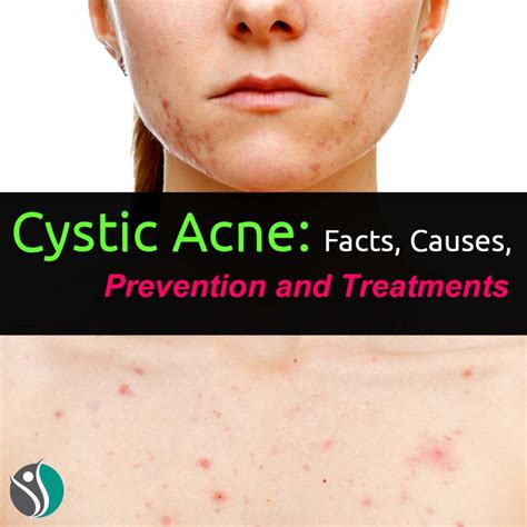 Cystic Acne: Facts, Causes, Prevention, and Treatments | Consumer ...