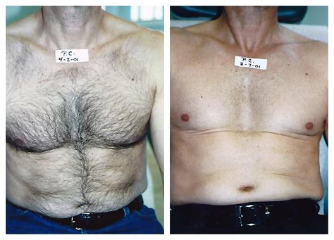 Laser Hair Removal for Men in Pittsburgh - Happel Laser Spa