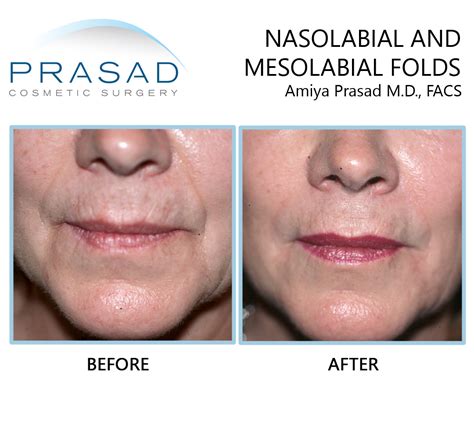 The Best Treatments for Lines around the Mouth | Dr. Prasad's Blog