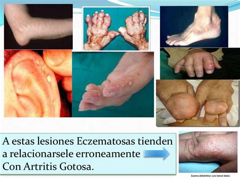 Artritis gotosa