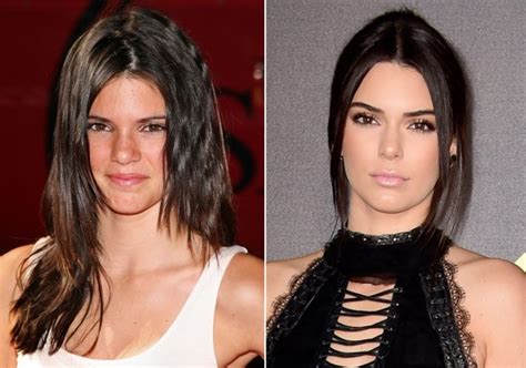 Kendall Jenner Before and After Plastic Surgery