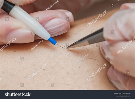 Best Electrolysis Hair Removal Royalty-Free Images, Stock Photos & Pictures | Shutterstock