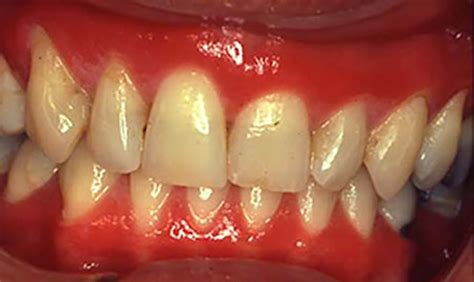 Plasma Cell Gingivitis: Investigate products that cause gingival hypersensitivity | Registered ...