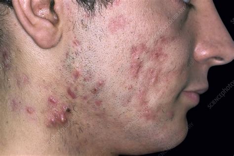 Nodulocystic acne on the face - Stock Image - C053/1913 - Science Photo Library