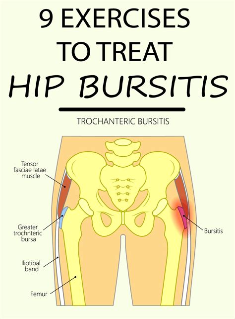 9 EXERCISES TO TREAT HIP BURSITIS | Bursitis hip, Bursitis, Hip ...