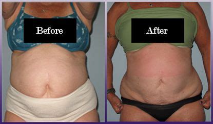 Liposuction Before & After Photos | St. Louis Laser Liposuction Center ...