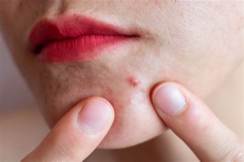 Nodular Acne: Symptoms, Causes, And How To Treat It | lupon.gov.ph