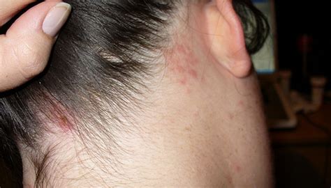 Shingles On Scalp Symptoms Pictures Contagious No Ras - vrogue.co