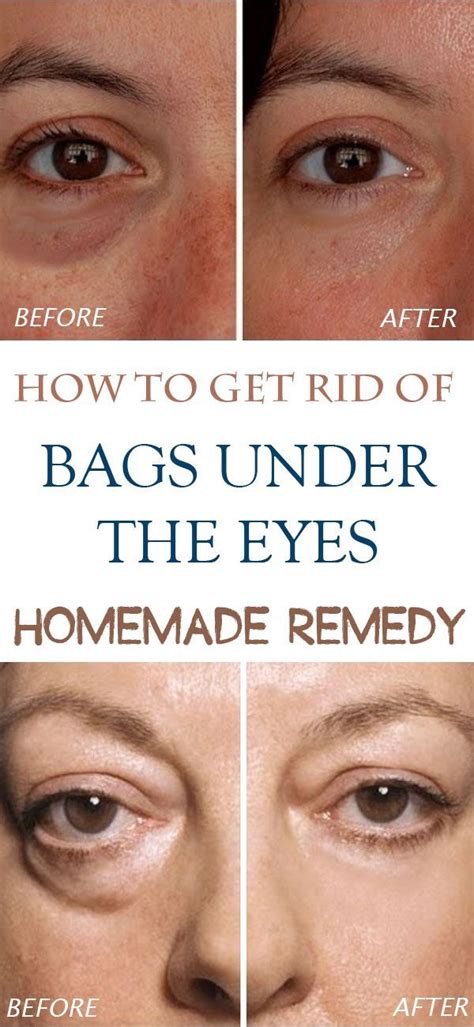 How to Get Rid of Puffy Eyes: Quick, Easy and Natural - Read: | Under eye bags, Beauty remedies ...