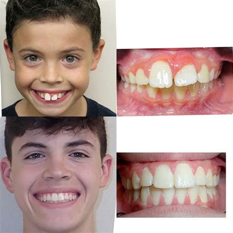 List 97+ Pictures Pictures Of Braces On Teeth Before And After Sharp