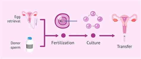 IVF process with donor sperm