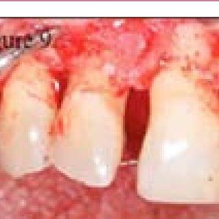 Removal of granulation tissue. | Download Scientific Diagram