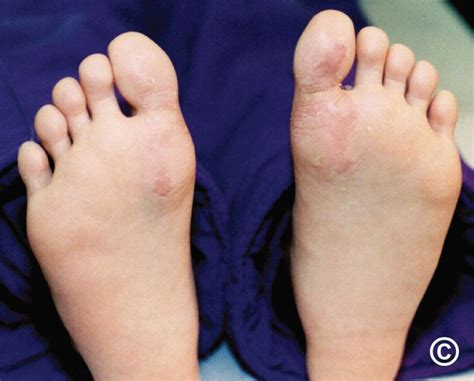 Juvenile plantar dermatosis