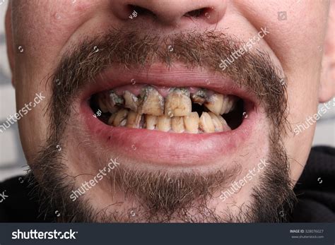 Bad Teeth Smoker Sick Stock Photo (Edit Now) 328076027