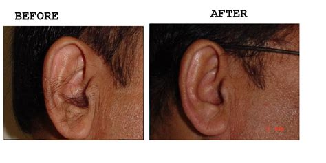 Ear Hair Removal – Amrit Clinic