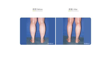 Calf Liposuction - Fats Surgery | Wish Aesthetic Surgery Clinic