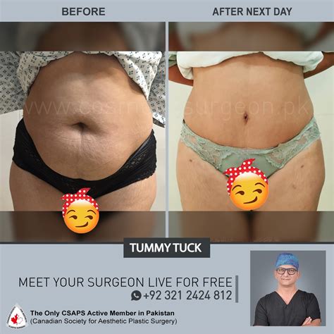 Tummy Tuck Before & After Results - Cosmetic Surgeon