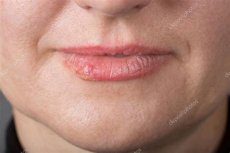 Lip infection with the herpes virus — Stock Photo © kopitin #88354680