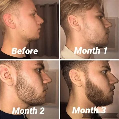 Beard Roller: Activate New Growth (Microneedle) - Bald & Beards