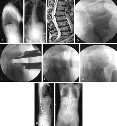 L1-S1 Fusion: When to Extend to T12 and Pelvis and When to Include L5-S1 Anterior Grafting ...