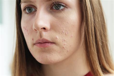 Zinc For Acne: Does It Help? — AENO