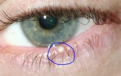 How To Remove Milia In Eyelid - HOWOTREMVO