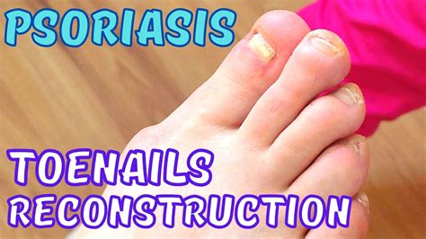 Psoriasis. Toenails reconstruction. - YouTube