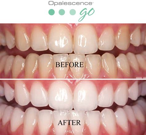 Teeth Whitening with Opalescence - Smile Care Dental Center