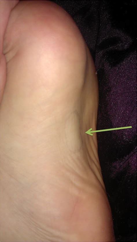 Ledderhose Disease Blog: Plantar Fibroma - a real pain in the foot