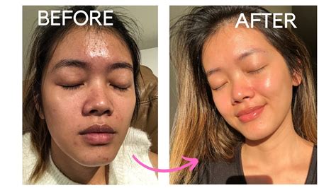 How I Get Rid of My Dehydrated Skin (ACNE JOURNEY in WINTER) - YouTube