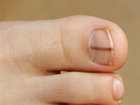 Picture 25 of Nail Bed Melanoma | bae-xkcx4